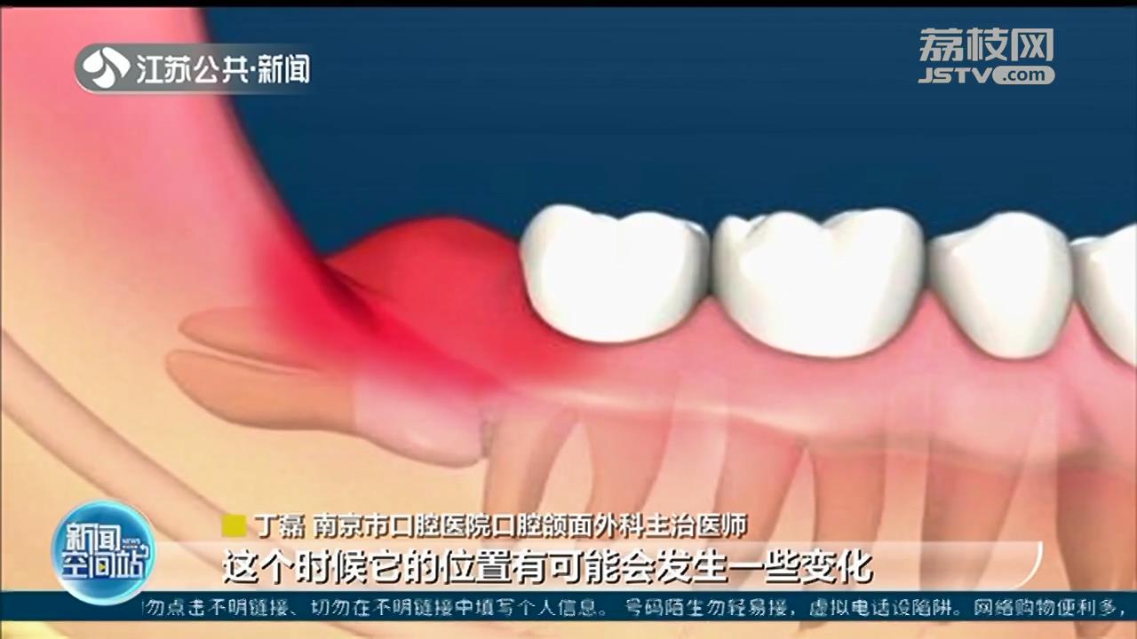 扬州女子智齿发炎硬扛好几年,左侧脸颊被脓肿穿破 智齿一定要拔吗?