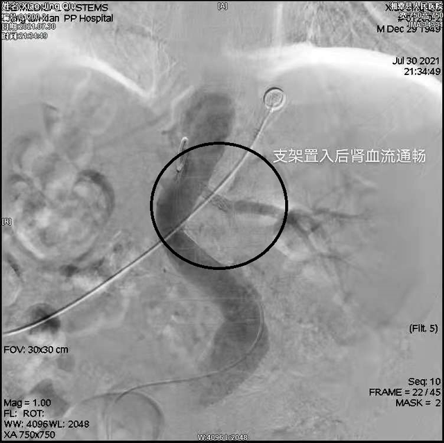 肾动脉成形术为患者护肾降压