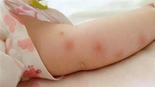 宝宝蚊虫叮咬急救攻略_潘廷猛_副主任医师_爱问健康