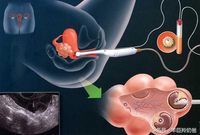 做试管婴儿的具体流程步骤，既幸福又心酸，女人坚强得让人心疼！