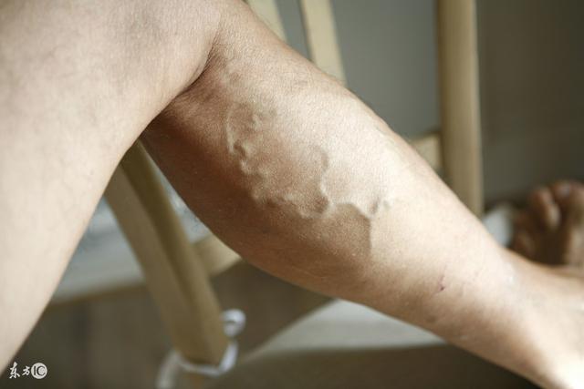 静脉曲张:下肢肌肉退化,循环不良!5对策活化肌肉