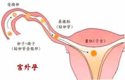 輸卵管副傘是什麼的症狀及緩減治療