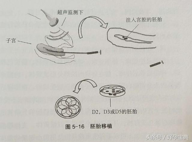 什么叫“试管婴儿”？试管婴儿治疗的条件和流程