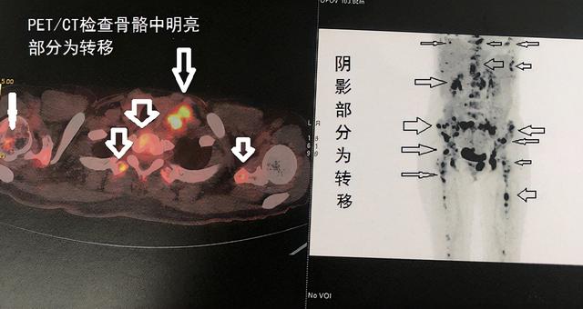 什么樣的疼痛應該小心是骨轉移？