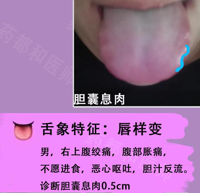 胆囊息肉，胆结石，肝囊肿？6种肝胆病变，看看舌象就知道