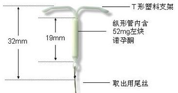 避孕环是什么原理（避孕环、节育环、宫内节育器是个啥）