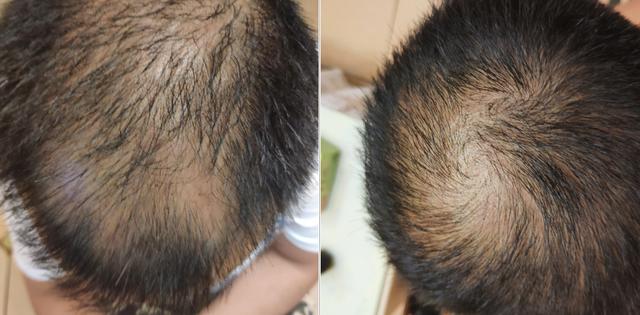 头面油腻、肥胖、脱发怎么办？中医让你避免“三十而腻”