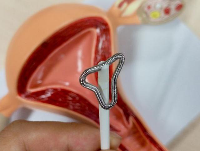 避孕环是什么原理避孕环节育环宫内节育器是个啥