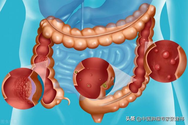 腸息肉一定要割了？醫生：越拖越危險，90%的大腸癌是它引起的