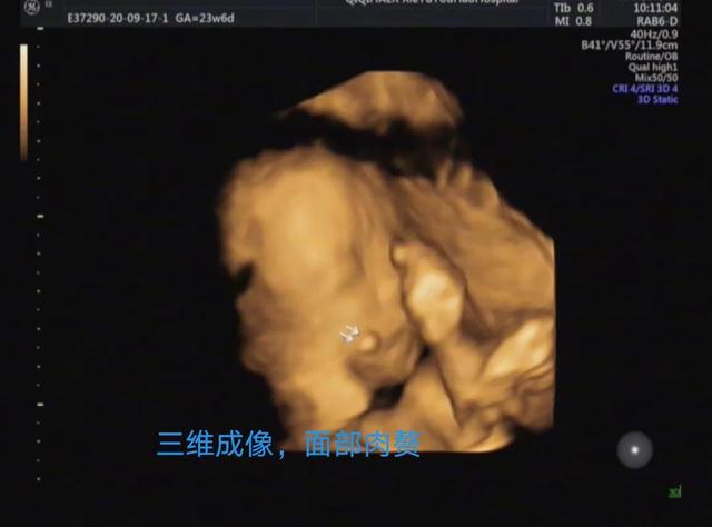 你也能看懂的胎儿畸形——病例分享
