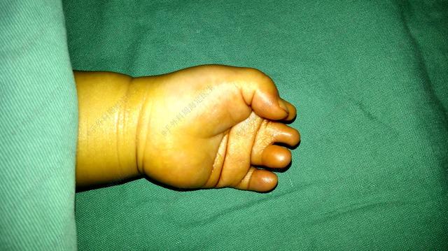 手外周海定为什么宝宝做完并指手术老是哭？听听医生怎么说