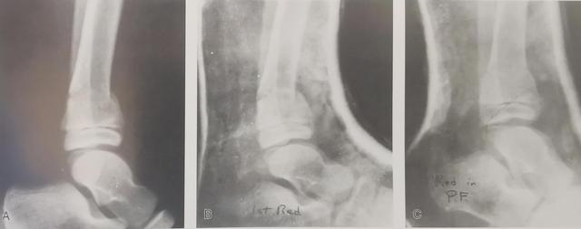 小儿胫骨远端骨折临床总结