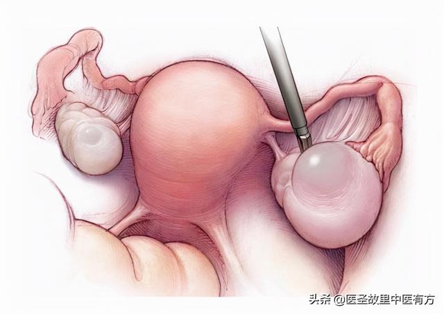 民间中药名方——消囊汤，13味药，可化痰湿、通气血、消囊肿