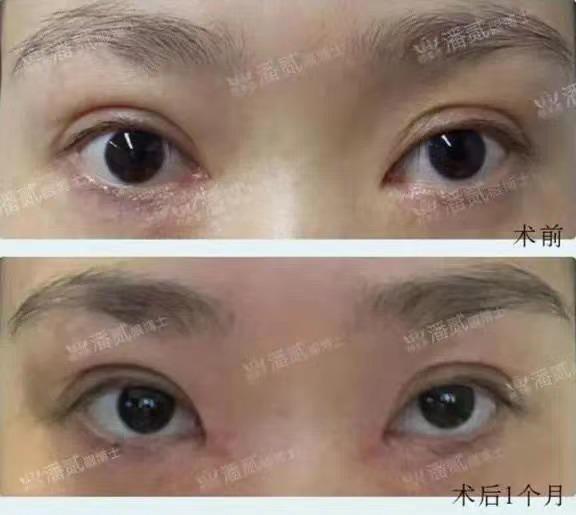 開了眼角後悔不已的案例 內眼角過大 露紅 括號 疤痕重 顯假 Kks資訊網