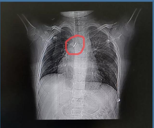 9岁男孩玩图钉，不小心吸入气管