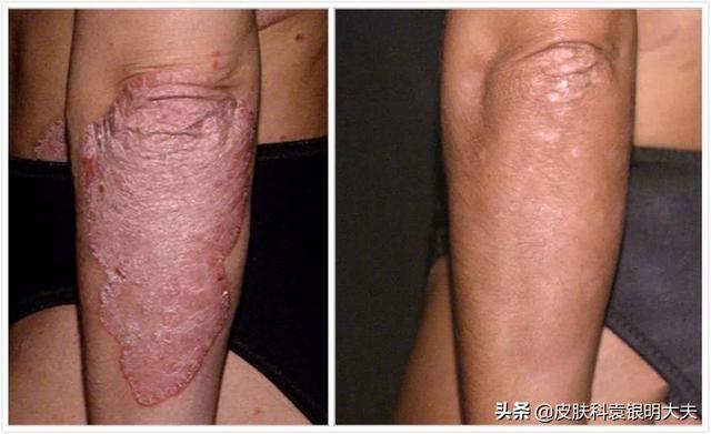 银宵癣图片(银癣症状图片)-扬升资讯网