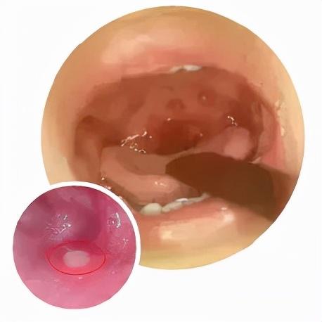 疱疹性咽峡炎进入高发期，如何防治看这里