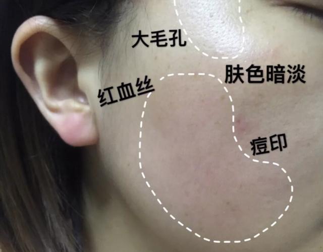 红血丝怎么去除最有效（去脸部红血丝的方法）