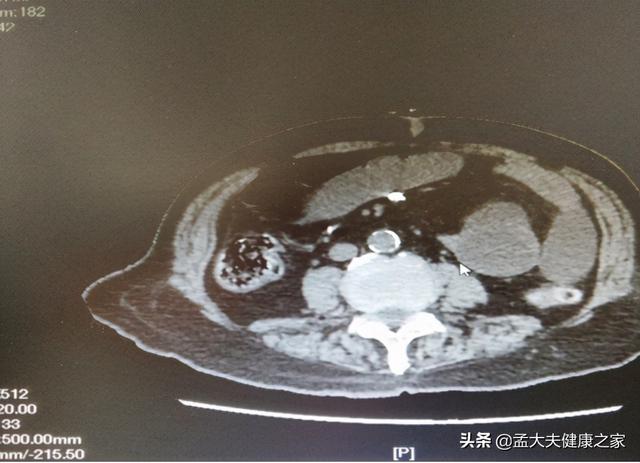 奥美拉唑一停，反酸、烧心就容易复发该怎么办？怎样能避免？