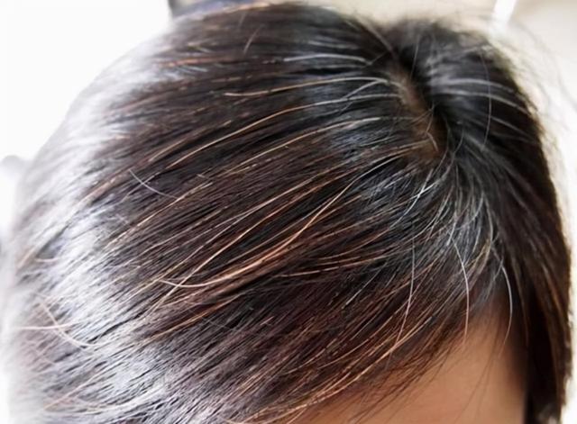 女子白头发日渐增多，别总觉得老了，或是缺了这3大营养素