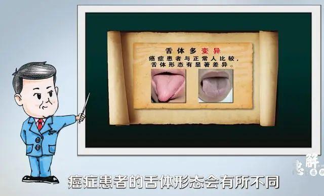 醫生提醒：癌變前，耳朵舌頭會“求救”！厚白苔肺癌，肝癭線肝癌