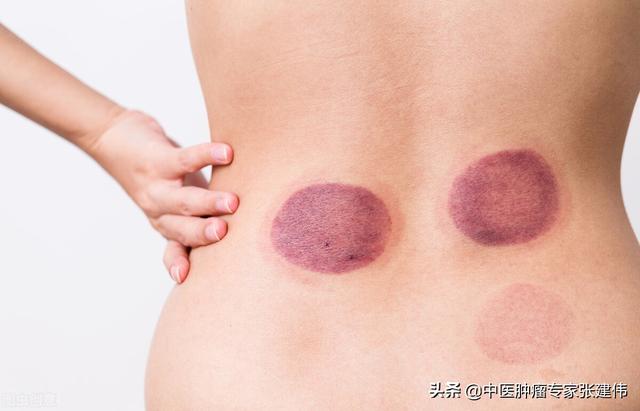 拔罐后皮肤又红又紫正常吗？中医教你如何通过拔罐辨体质