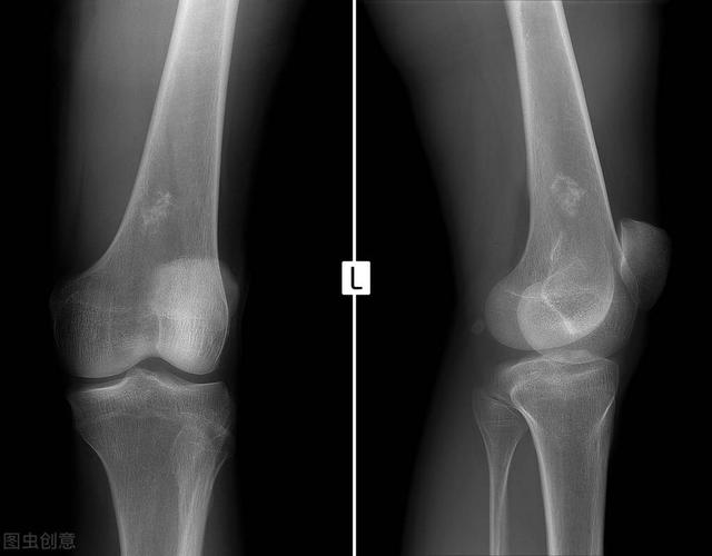硬化性骨髓炎有哪些症狀 Kks資訊網