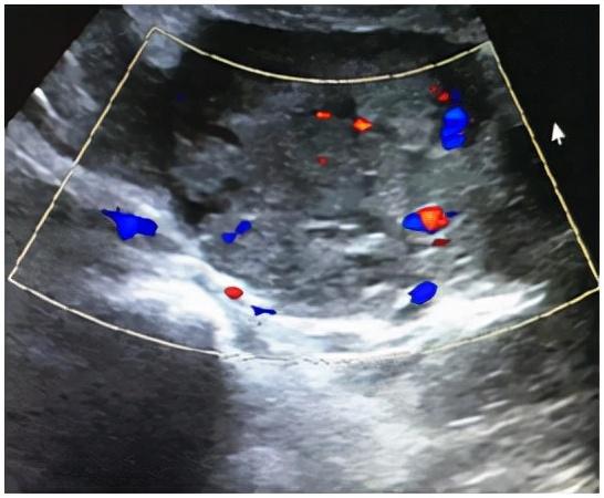 双胞胎隔“宫”相望，医生“攘外安内”