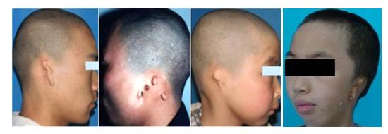 孩子没有耳朵怎么办？外耳再造术可以帮助你！