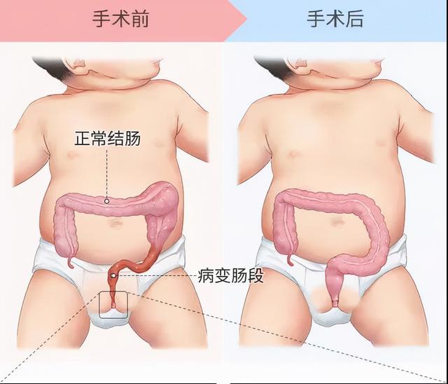 孩子喊肚子疼切勿轻视，当心小病拖成大病