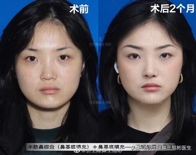 月亮脸 改造的关键是 广州隆鼻 太阳信息网
