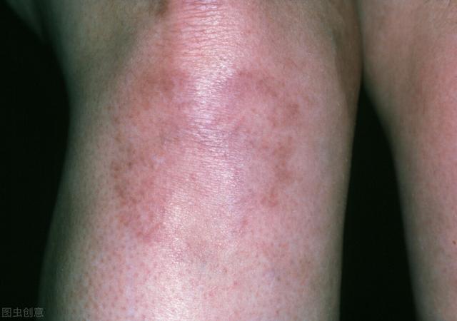 出现这些症状，是系统性红斑狼疮找上门了