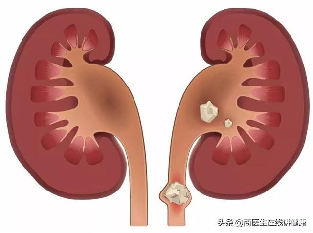 骨质疏松，钙片啥时候吃最好？会不会致肾结石？