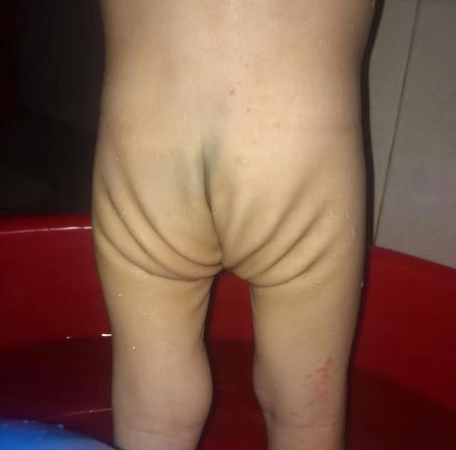 宝宝不吃饭日渐消瘦可能是疳积，欧阳医生教你辨别孩子是否有疳积