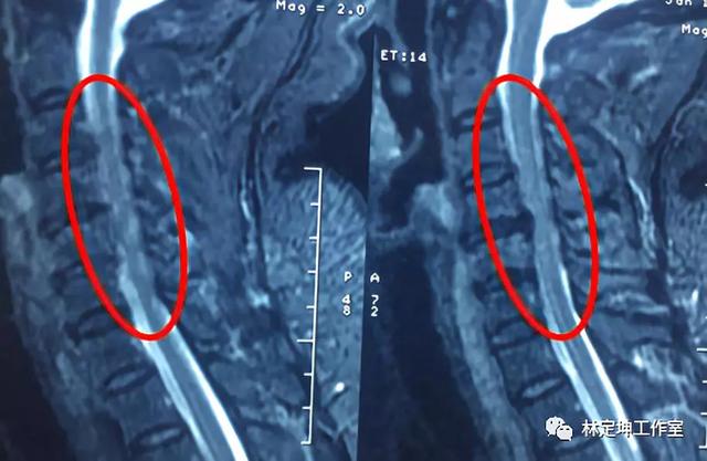 医林正骨丨脊髓型颈椎病得赶紧手术 这些症状的病人 手术非首选 全网搜