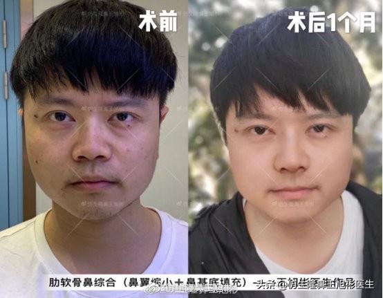 男士隆鼻 鼻综合 鼻基底填充 缩鼻翼 侧颜男神上线 今日热点