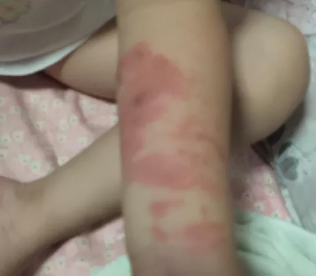 一岁幼童被热水烫伤，爷爷用冷水冲5分钟起作用！还有这几个步骤也要记牢