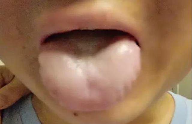 舌头胖大用参苓白术丸没用？胖大舌也分三种，教你如何对症调理