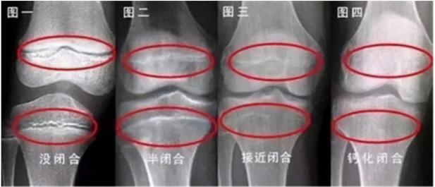 13岁男孩160cm，骨骺线快要闭合，提醒：出现2个特征前，抓紧补救