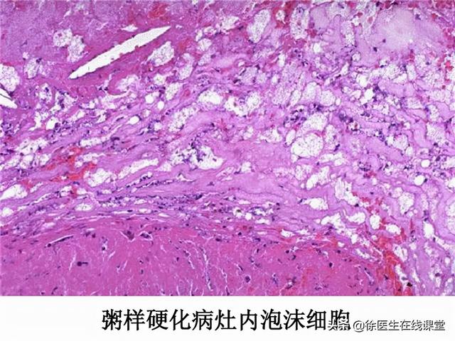 低密度脂蛋白胆固醇升高，饮食要注意哪些？