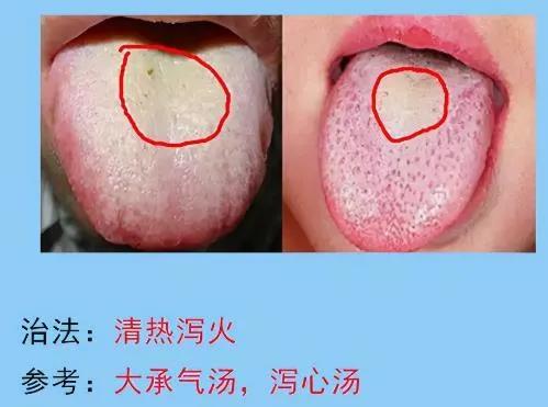 脾胃病的常见舌苔分析，脾胃不好的人要多多了解，你是图几？