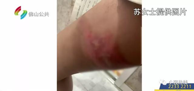 8岁女童在酒楼不慎滑倒，全身多处被烫伤化脓！妈妈：酒楼未做好防护措施