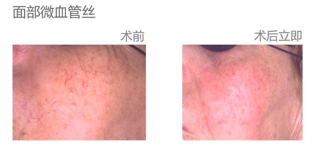 红血丝怎么去除最有效（去脸部红血丝的方法）