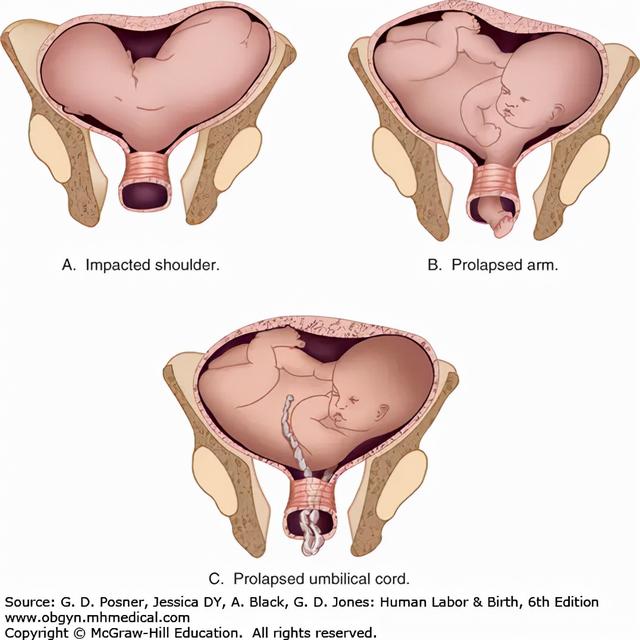 惨的不只有早产，还有麻醉过早失效的剖腹产