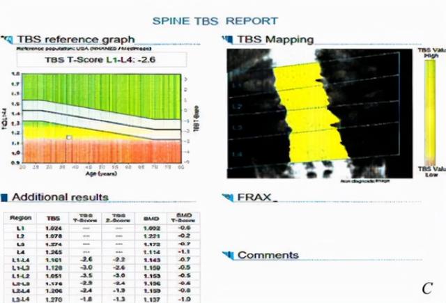 60岁骨质疏松，怎么补都没用？医生：罪魁祸首是食盐