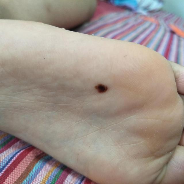 千万别大意，小孩脚底长痣最好去医院