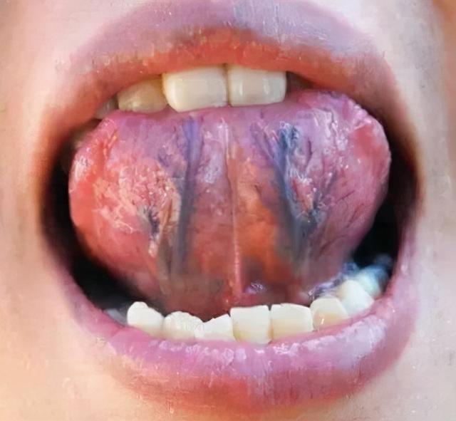 舌为心之苗:心脏不好,舌头或会有4个变化,不妨对照一下