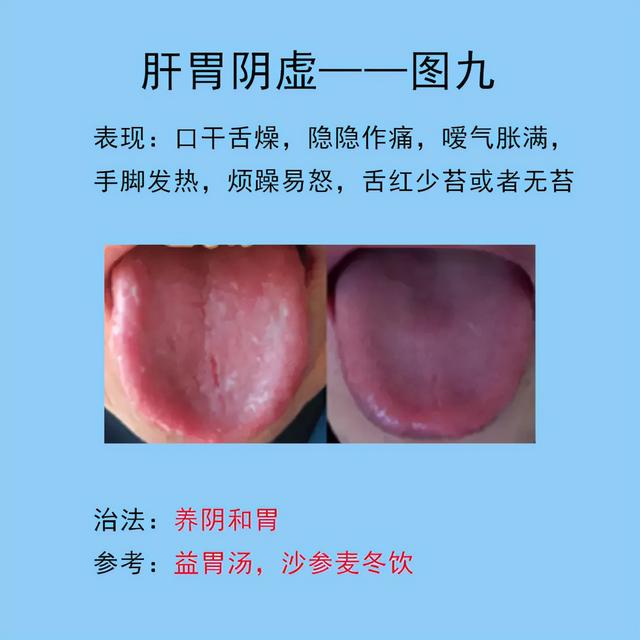 脾胃常见的10种舌象，以及临床表现，后面带解决方法