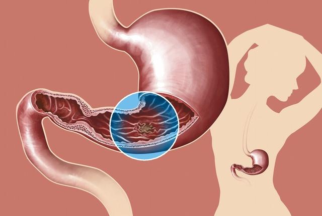 胃病不仅要用药，主要在于养，养胃应该怎么做？