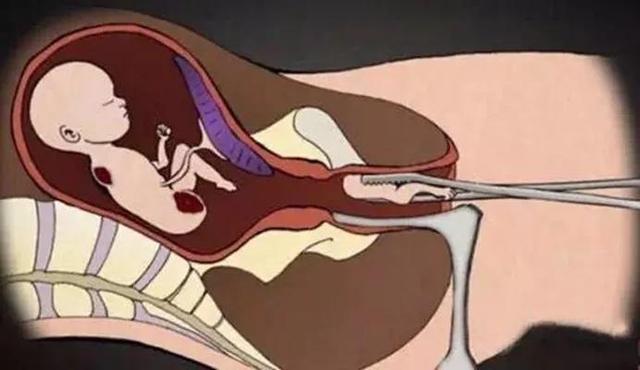 早孕人工流产和中孕引产手术操作过程及风险